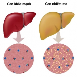 NGUYÊN NHÂN VÀ ĐIỀU TRỊ  BỆNH GAN NHIỄM MỠ