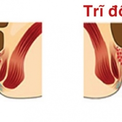 TRIỆU CHỨNG & CÁCH ĐIỀU TRỊ BỆNH TRĨ
