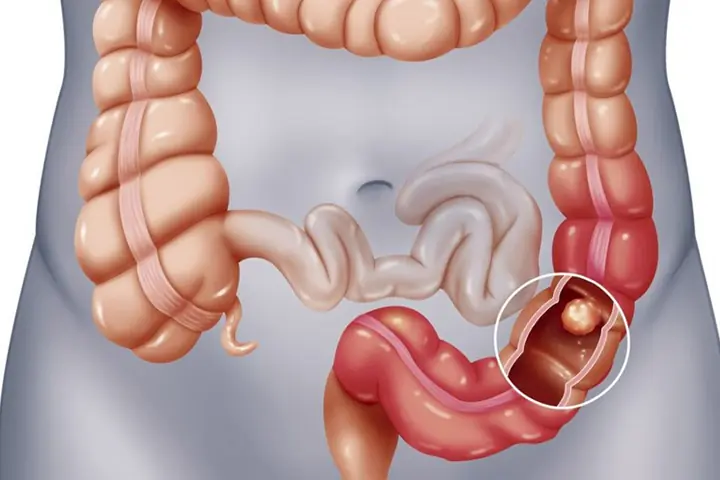 Cách phòng ngừa bệnh viêm đại tràng