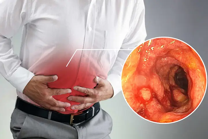 Các triệu chứng bệnh viêm đại tràng