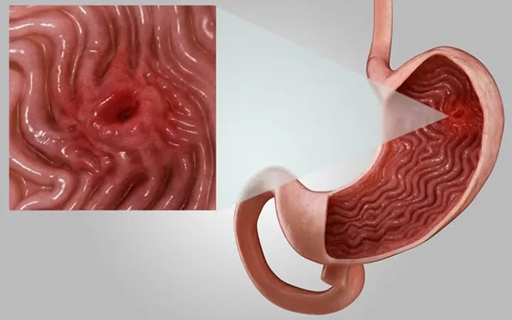 Vi&ecirc;m dạ d&agrave;y cấp l&agrave; g&igrave;?