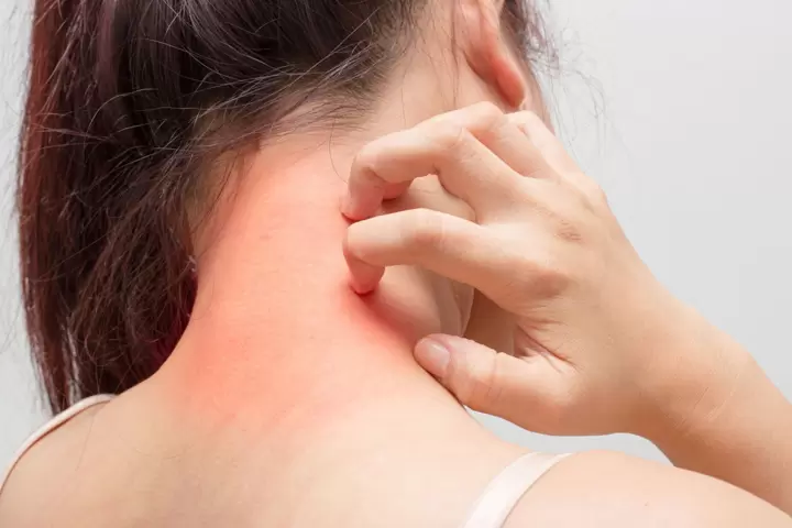 G&acirc;y dị ứng